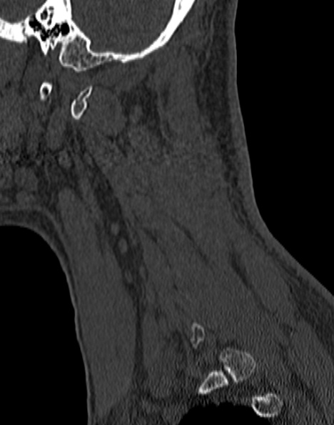Cervical spondylodiscitis (Radiopaedia 28057-29489 Sagittal bone window 53).jpg
