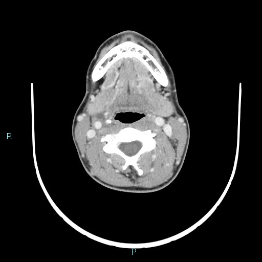 Cervical thymic cyst (Radiopaedia 88632-105335 C 70).jpg
