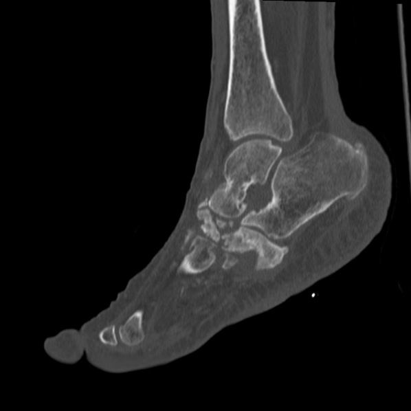 File:Charcot joint (Radiopaedia 36629-38194 Sagittal bone window 44).jpg