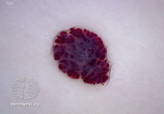 File:Cherry angioma dermoscopy (DermNet NZ 159596).jpg