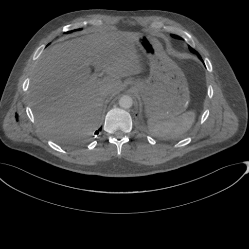 File:Chest multitrauma - aortic injury (Radiopaedia 34708-36147 A 266).png