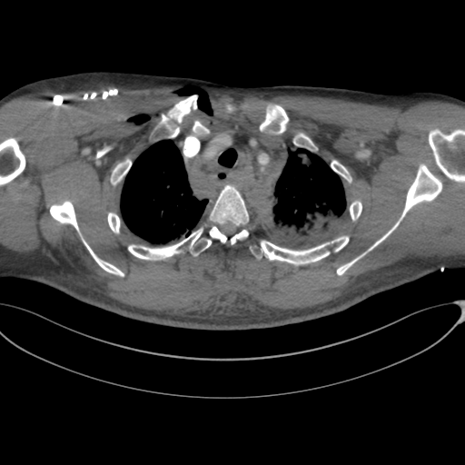 File:Chest multitrauma - aortic injury (Radiopaedia 34708-36147 A 58).png