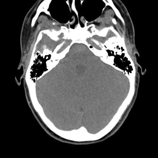 Chiari I malformation and obstructive hydrocephalus (Radiopaedia 41185-43981 D 22).png