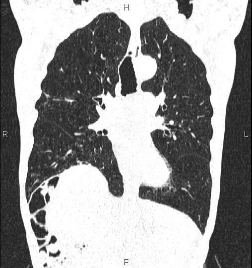 Chilaiditi sign (Radiopaedia 88839-105611 Coronal lung window 31).jpg