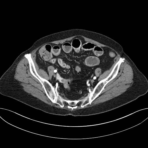 Cholecystoduodenal fistula due to calculous cholecystitis with gallstone migration (Radiopaedia 86875-103077 A 57).jpg