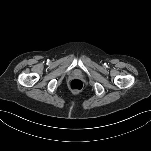 Cholecystoduodenal fistula due to calculous cholecystitis with gallstone migration (Radiopaedia 86875-103077 A 77).jpg