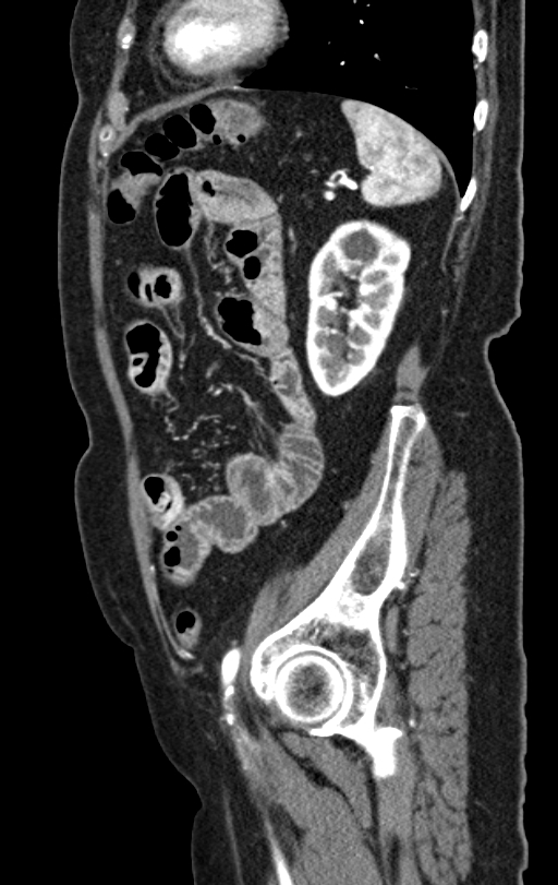 Cholecystoduodenal fistula due to calculous cholecystitis with gallstone migration (Radiopaedia 86875-103077 C 16).jpg