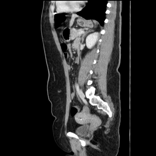 Choledocholithiasis on CT and MRI (Radiopaedia 24825-25087 D 39).jpg