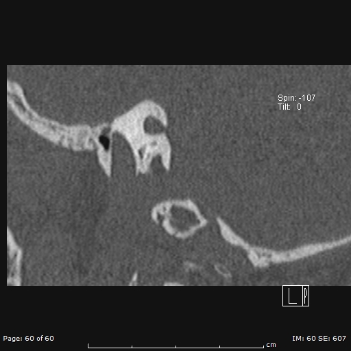 Cholesteatoma - external auditory canal (Radiopaedia 88452-105096 Sagittal bone window 60).jpg