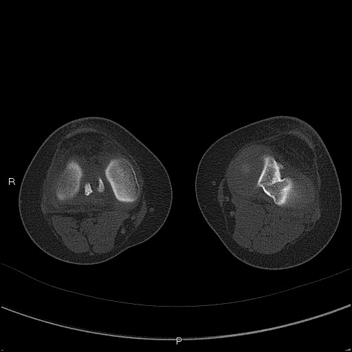 Chondroblastoma (Radiopaedia 62721-71030 Axial bone window 36).jpg