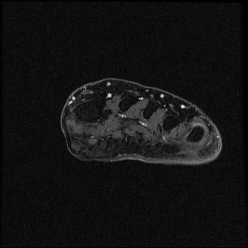 File:Chondroblastoma - midfoot (Radiopaedia 64831-73765 G 30).jpg