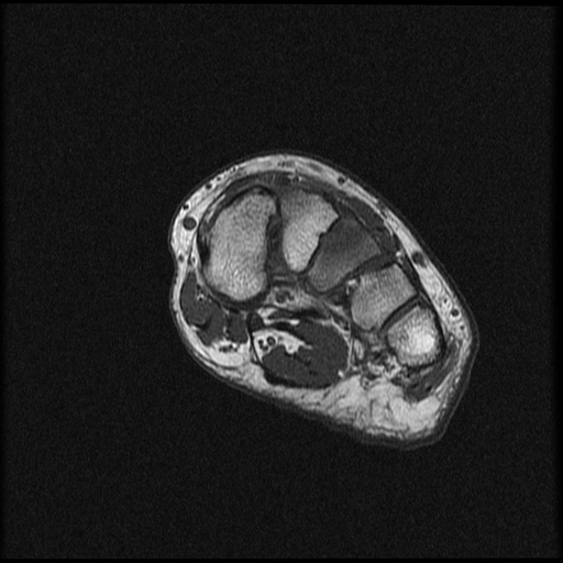 File:Chondroblastoma - midfoot (Radiopaedia 64831-73765 Short axis T1 17).jpg