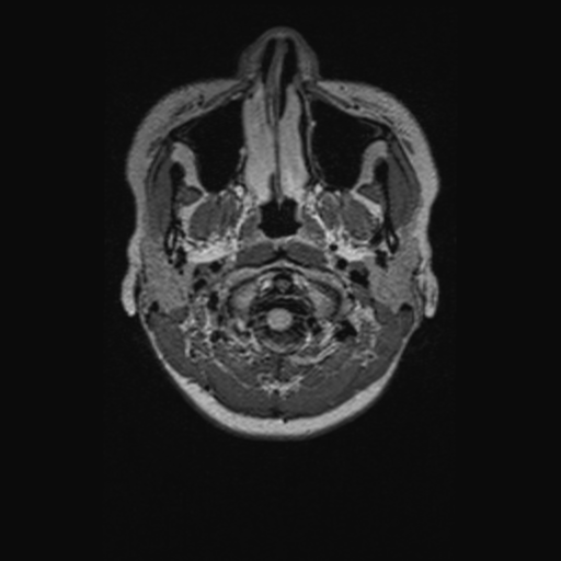 Chondrosarcoma (Radiopaedia 41937-44939 Axial FLAIR 4).png