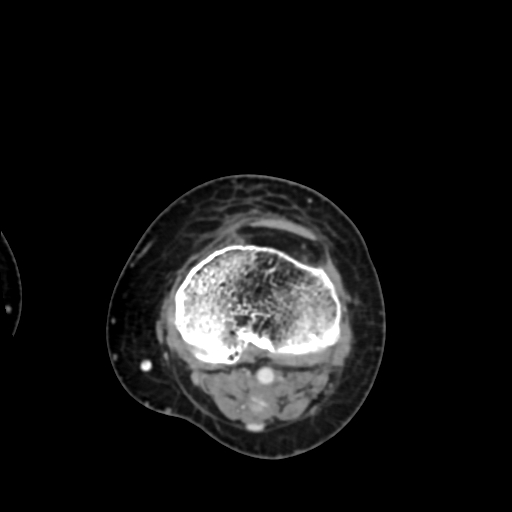 Chondrosarcoma - femur (Radiopaedia 64187-72954 Axial with contrast 62).jpg