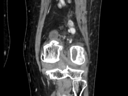Chondrosarcoma - femur (Radiopaedia 64187-72954 C 42).jpg