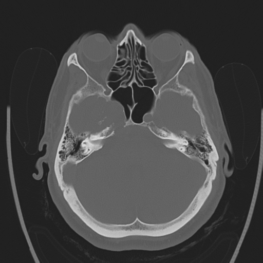File:Chondrosarcoma of skull base- grade II (Radiopaedia 40948-43653 Axial bone window 12).png