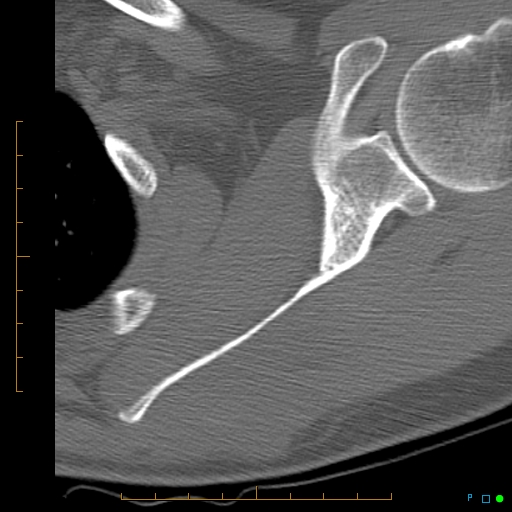 File:Chondrosarcoma of the scapula (Radiopaedia 30696-31399 Axial non-contrast 4).jpg