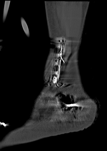 Chopart fracture (Radiopaedia 35347-36861 Sagittal bone window 61).jpg
