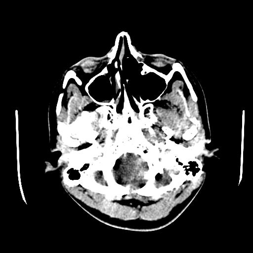 File:Choriocarcinoma of ovary with cerebral and pulmonary metastases (Radiopaedia 25983-26118 C+ arterial phase 8).jpg