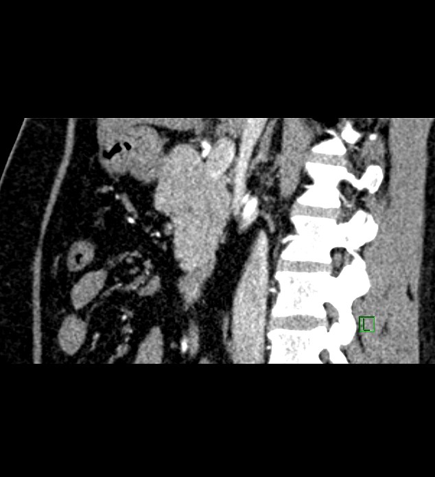 Chromophobe renal cell carcinoma (Radiopaedia 84286-99573 F 95).jpg
