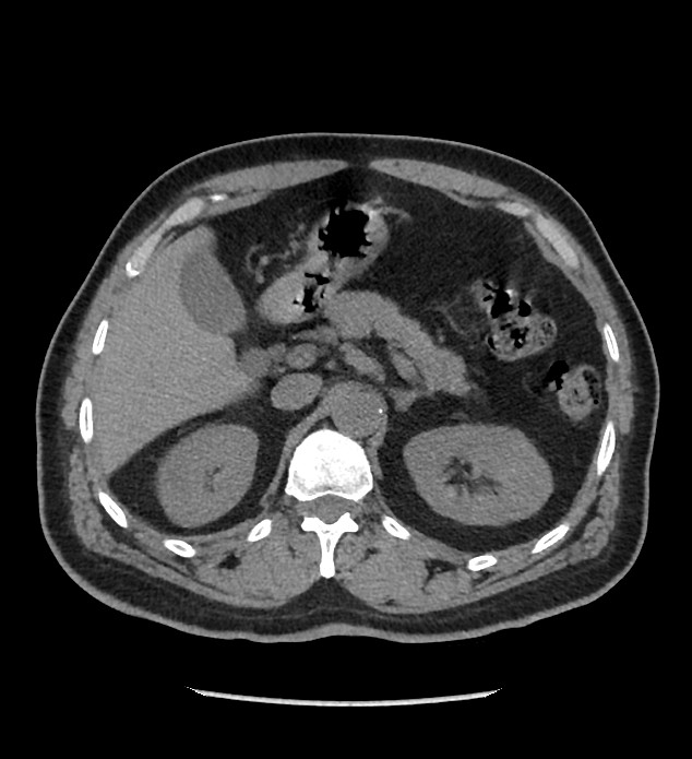 Chromophobe renal cell carcinoma (Radiopaedia 86879-103083 Axial non-contrast 23).jpg