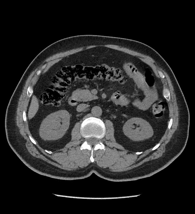 Chromophobe renal cell carcinoma (Radiopaedia 86879-103083 Axial non-contrast 39).jpg