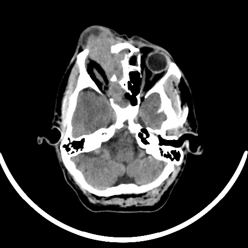 File:Chronic invasive fungal sinusitis with intraorbital and intracranial extension (Radiopaedia 56387-63046 Axial non-contrast 126).jpg