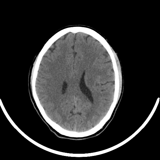 Chronic invasive fungal sinusitis with intraorbital and intracranial extension (Radiopaedia 56387-63046 Axial non-contrast 237).jpg