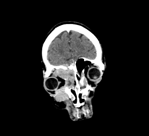 Chronic invasive fungal sinusitis with intraorbital and intracranial extension (Radiopaedia 56387-63046 C 70).jpg