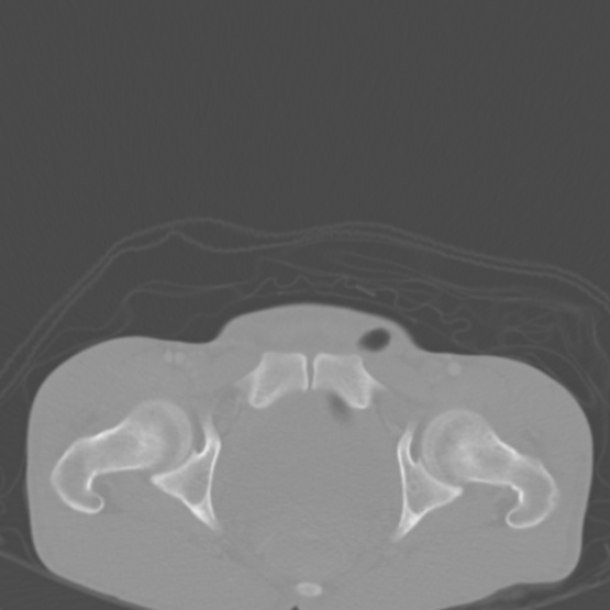 Chronic large bowel pseudo-obstruction (Radiopaedia 43181-46492 Axial bone window 159).jpg