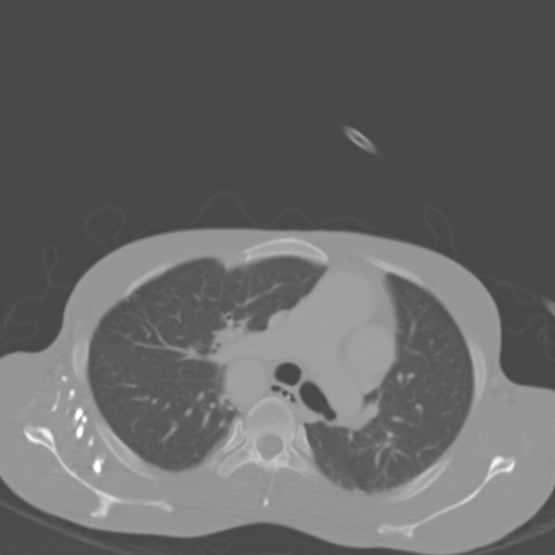 Chronic large bowel pseudo-obstruction (Radiopaedia 43181-46492 Axial bone window 4).jpg