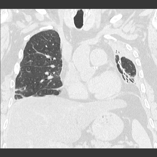 Chronic lung allograft dysfunction - restrictive form (Radiopaedia 60595-68316 Coronal lung window 49).jpg