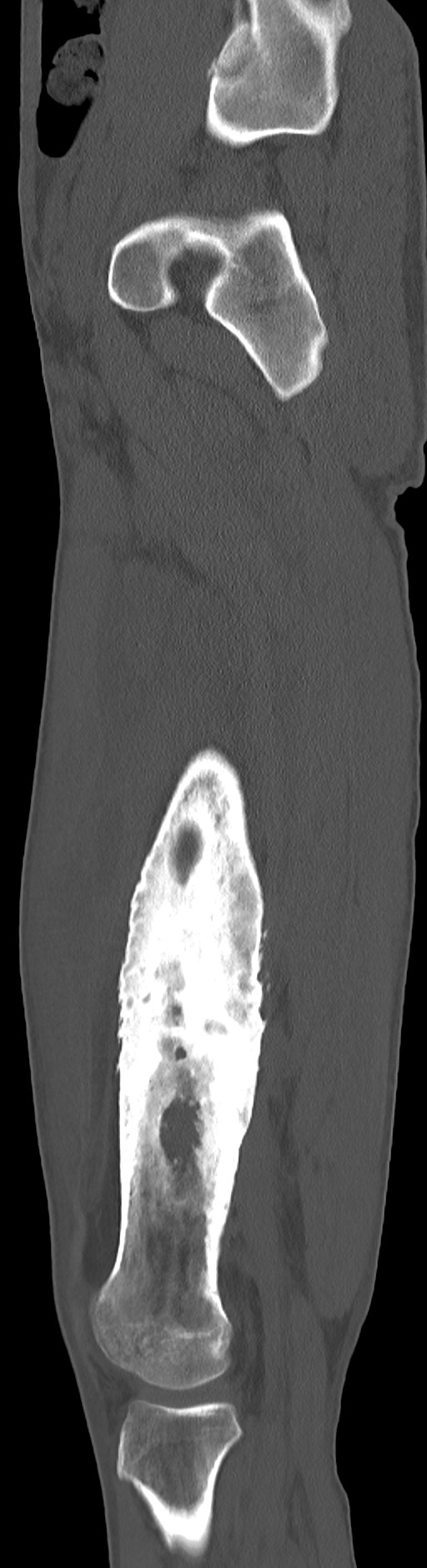 Chronic osteomyelitis (with sequestrum) (Radiopaedia 74813-85822 C 76).jpg
