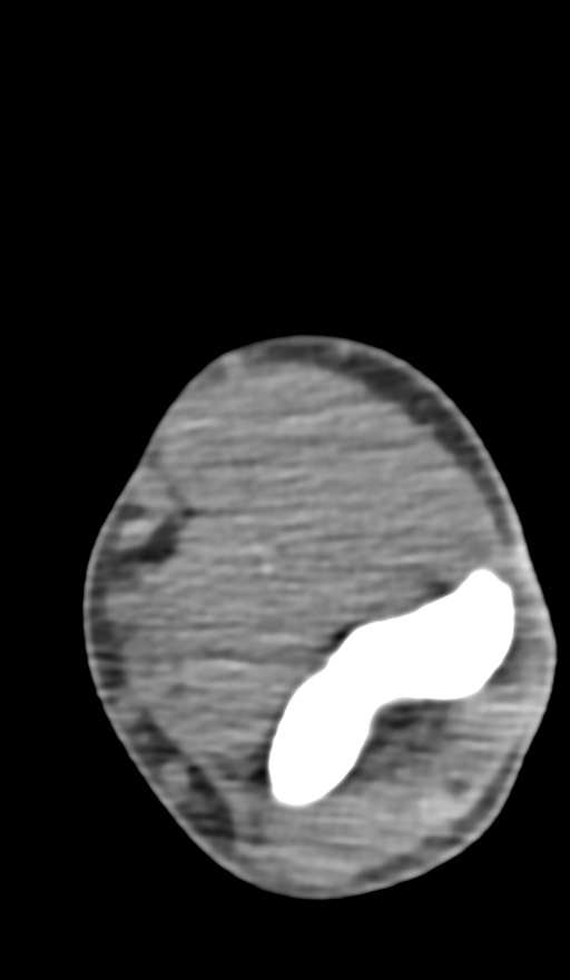 Chronic osteomyelitis of the distal humerus (Radiopaedia 78351-90971 Axial non-contrast 85).jpg