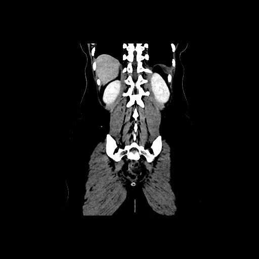Chronic portal venous thrombosis with cavernous transformation (Radiopaedia 73618-84398 B 86).jpg