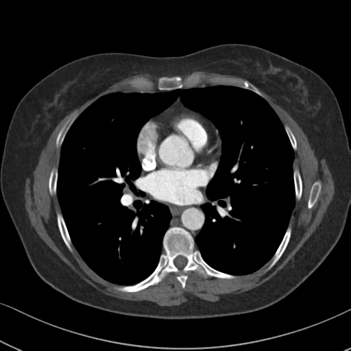 Chronic pulmonary embolus (Radiopaedia 39129-41341 Axial C+ CTPA 57).png