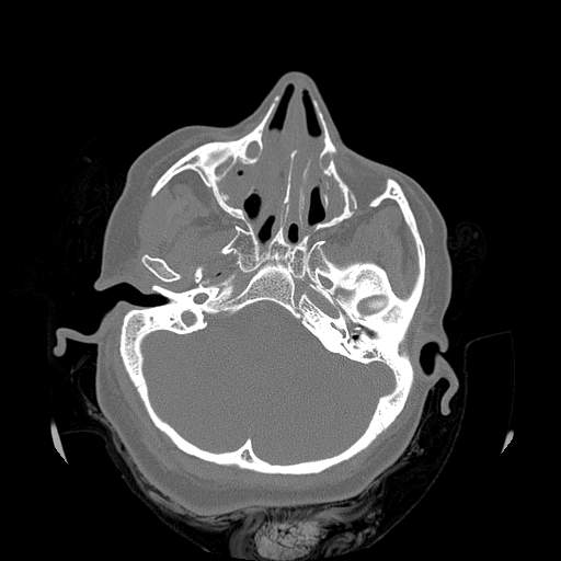 Chronic sinusitis with intra-sinus calcification (Radiopaedia 63919-72668 Axial bone window 42).jpg