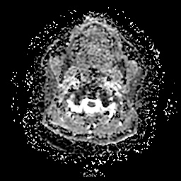 File:Chronic submandibular sialadenitis (Radiopaedia 61852-69885 Axial ADC 10).jpg