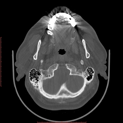 Chronic submandibular sialolithiasis (Radiopaedia 69817-79814 Axial bone window 11).jpg