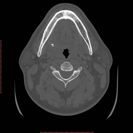 File:Chronic submandibular sialolithiasis (Radiopaedia 69817-79814 Axial bone window 68).jpg