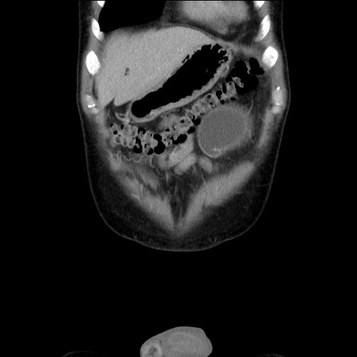 Chronic ureteropelvic junction obstruction (Radiopaedia 78365-90996 B 20).jpg
