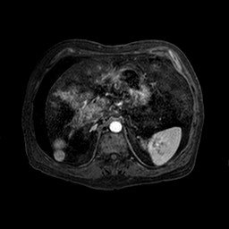 Cirrhosis and hepatocellular carcinoma in the setting of hemochromatosis (Radiopaedia 75394-86594 Axial T1 C+ fat sat 132).jpg