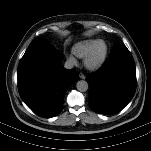 File:Classic complicated silicosis (Radiopaedia 49720-54961 Axial liver window 43).jpg