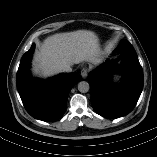 File:Classic complicated silicosis (Radiopaedia 49720-54961 Axial liver window 47).jpg
