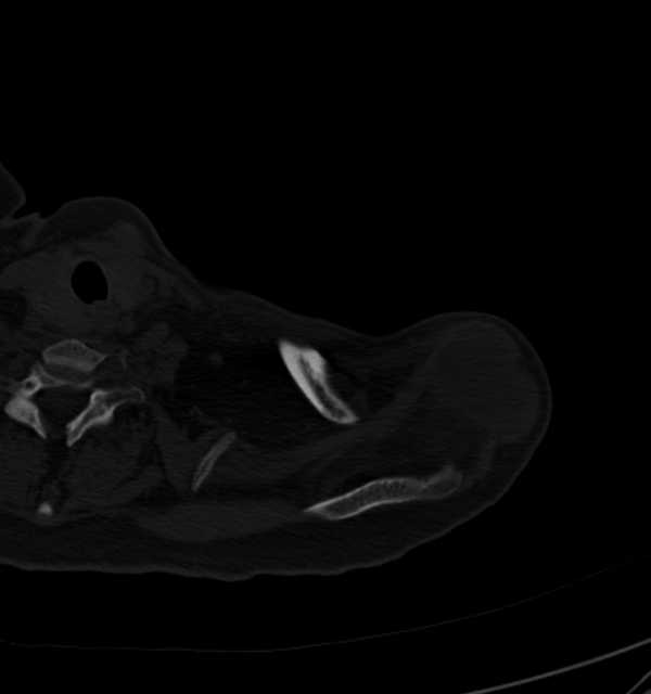 Clear cell chondrosarcoma - humerus (Radiopaedia 63104-71612 Axial bone window 13).jpg