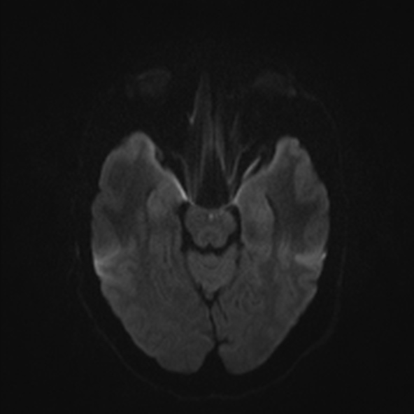 File:Clival meningioma (Radiopaedia 53278-59248 Axial DWI 34).jpg