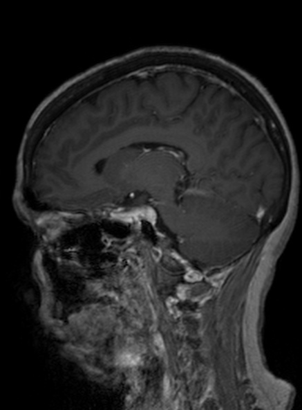 File:Clival meningioma (Radiopaedia 53278-59248 Sagittal T1 C+ 281).jpg