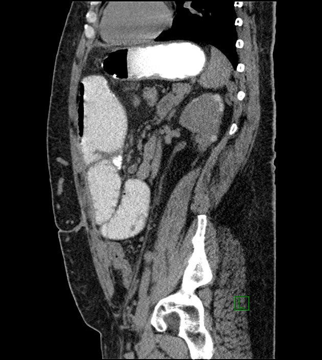 Closed-loop small bowel obstruction-internal hernia (Radiopaedia 78439-91096 C 56).jpg