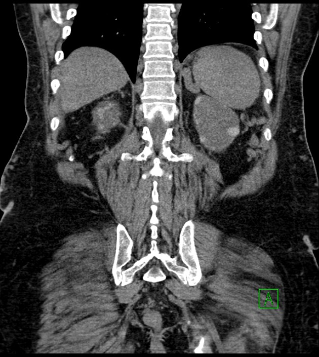 Closed-loop small bowel obstruction-internal hernia (Radiopaedia 78439-91096 Coronal non-contrast 79).jpg