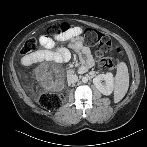 File:Closed loop obstruction - internal hernia into nephrectomy bed (Radiopaedia 59867-67320 Axial 27).jpg